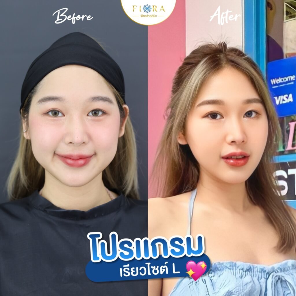 จัดการตีนกาอยู่หมัด! ด้วยโบท็อกซ์ ลดริ้วรอย